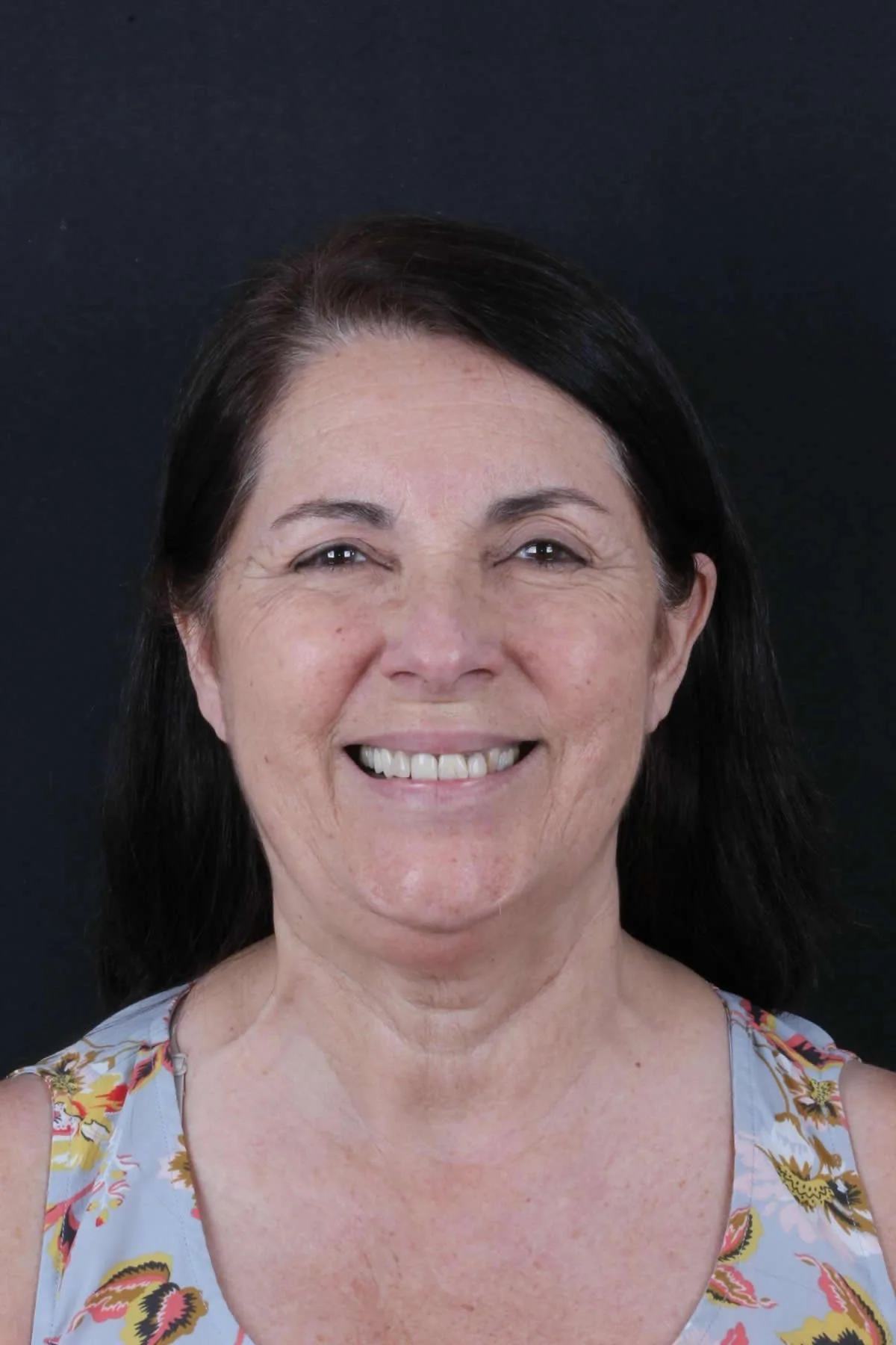 Reabilitação de implantes e resinas — foto 2